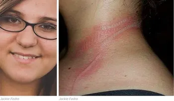 Una adolescente sufre quemaduras por usar el móvil mientras se cargaba la batería.