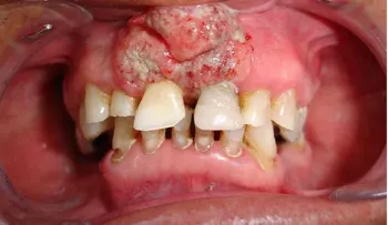 Confirman que el sexo oral provoca cáncer bucal