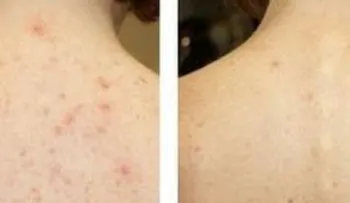 ¡Descubre el mejor secreto para curar el acné de la espalda... 