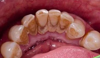Truco para la placa dental!!!