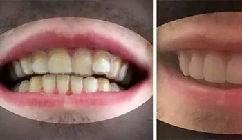 Estudiante diseña sus propios aparatos dentales por 60$ y se ahorra 8000$