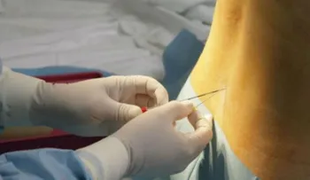 Una mujer mantuvo 14 años una aguja en su columna vertebral, y tendría que vivir con ella el resto de su vida 