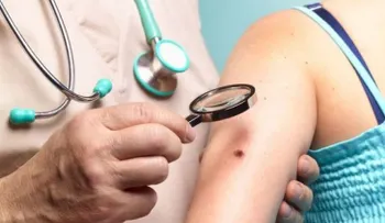 1 de cada 53 personas desarrollará melanoma a lo largo de su vida