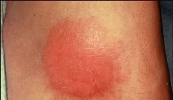 Granuloma anular, causas y síntomas