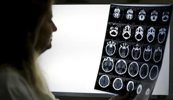 ?omer cerebros humanos protegió a una tribu de las enfermedades cerebrales