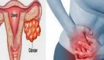 Este remedio ayudará a las mujeres a combatir el cáncer de ovario