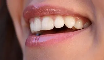 Remedios caseros para los labios partidos 