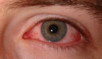 Si trabaja en una computadora descansa cada 20 minutos: Los ojos llorosos y cómo tratarlos 