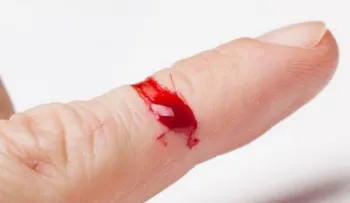 Daños articulares y hemorragias severas son padecidos por pacientes con hemofilia