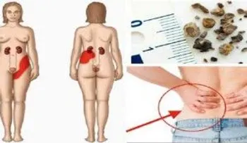 5 síntomas y signos de cálculos renales
