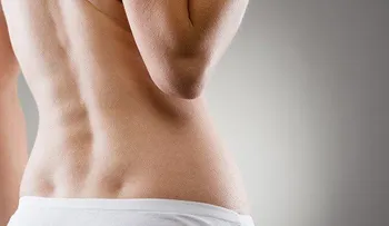 5 maneras de aliviar naturalmente el dolor de espalda por escoliosis