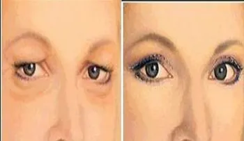 Reafirmar los párpado caído de forma natural con este remedio ¡es maravilloso!