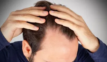 Cómo frenar la caída del cabello con estos 10 pasos