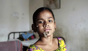 Operan con éxito a la "niña árbol" bangladesí