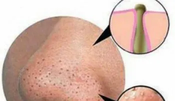 Receta para quitar los puntos negros de la cara