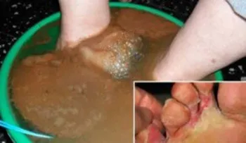 Mis pies se estaban pudriendo por un hongo y esta receta natural fue mi solución 
