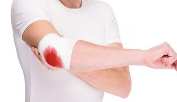 Tratamientos innovadores ayudan a evitar sangrados en pacientes con hemofilia