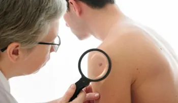 ¿Sabías que el cáncer de piel es el más frecuente en el mundo?