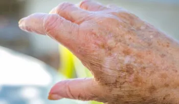 5 remedios caseros para eliminar manchas por la edad