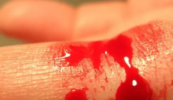 La hemofilia es una condición poco frecuente pero tiene altos riesgos