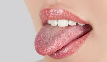Remedios caseros para tratar la candidiasis bucal