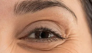 La hinchazón debajo de los ojos puede acabarse