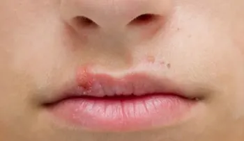 El molesto Herpes, todo lo que debes saber sobre él