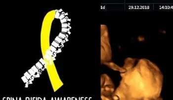 Médicos sacan bebé de seis meses del útero de la madre para curar su médula espinal, y lo vuelven a colocar