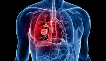  Un tratamiento triplica supervivencia en cáncer de pulmón no microcítico ALK+ 