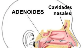 Adenoides, síntomas y tratamiento