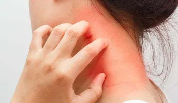 Dos de cada 10 adolescentes en Latinoamérica padecen dermatitis atópica