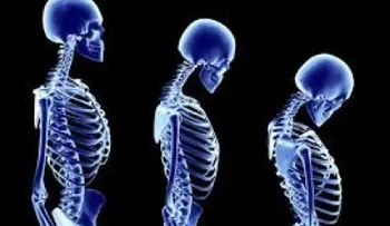 Osteoporosis: Una enfermedad silenciosa que también ataca a los hombres
