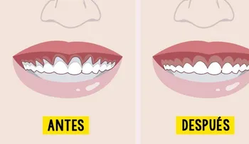 6 remedios naturales para combatir la retracción de las encías