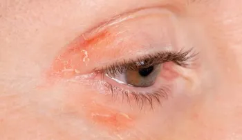 Los daños que puede traer usar maquillaje vencido