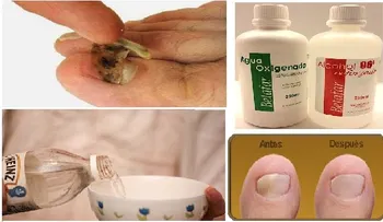 Elimina todos los hongos de las uñas de una pasada