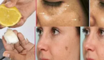 Estos remedios caseros eliminan las manchas oscuras de forma permanente