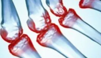 Sale a la luz la cura para la artritis, reumatismo y enfermedades de las articulaciones !!