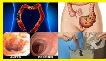 Excelente remedio que elimina toda la mugre y caca acumulada del colon