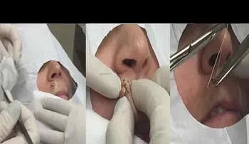 INCREIBLE: extracción de una espinilla de la cara de una señora