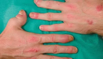 Artritis psoriásica: Deformación e inflamación articular