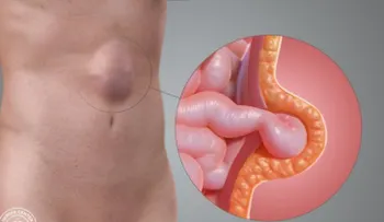 Las hernias abdominales son comunes, pero no necesariamente peligrosas