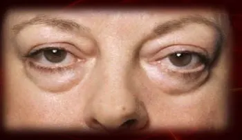 La única forma de corregir las bolsas de los ojos