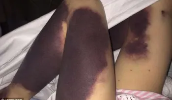 Esta niña de 4 años despertó con hematomas en todas sus piernas. La verdad te dejará sin palabras...
