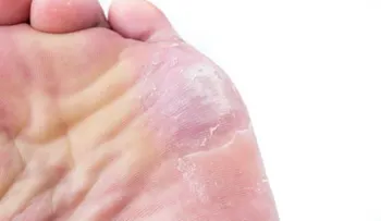Por qué me pican los pies