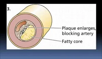 La hipertensión arterial es el factor de riesgo que produce más muertes (VIDEO)