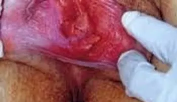 Curas para vestibulitis vulvar