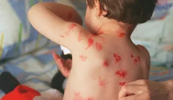 Le dijeron que su hijo tenía varicela...pero se dio cuenta que los médicos cometían un error 