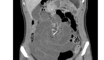 Esta mujer vivió 10 años con un alambre dental en su intestino