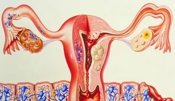 ¡Cuidado con el cáncer de ovario!