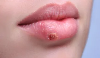 ¿Por qué el herpes labial siempre se repite?